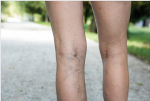 Varicose Vein Cure Adelaide