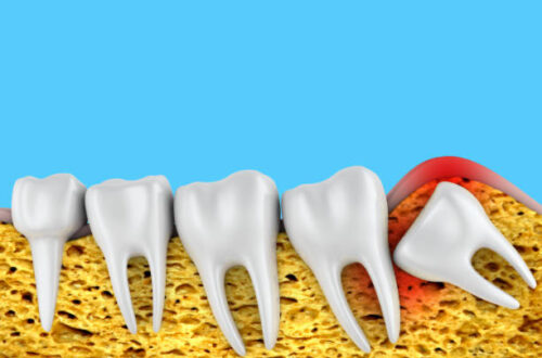 wisdom teeth removal Adelaide