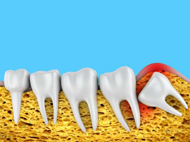 wisdom teeth removal Adelaide