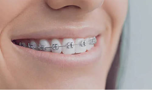 dental braces Adelaide