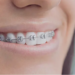 dental braces Adelaide