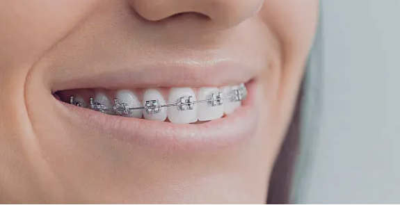 dental braces Adelaide